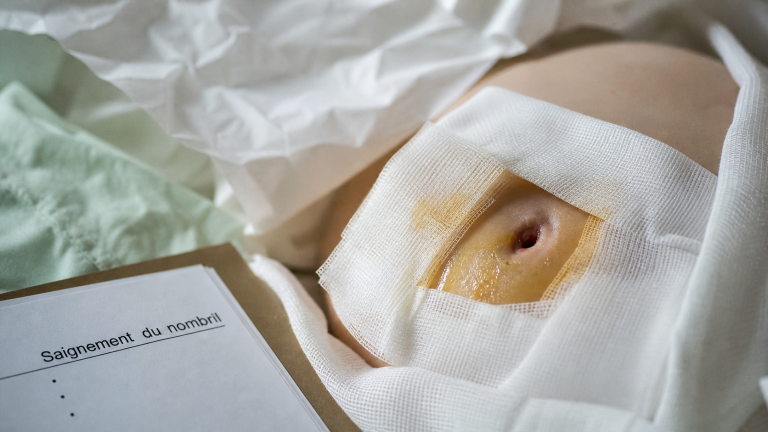 Nombril qui saigne : infection ou endométriose